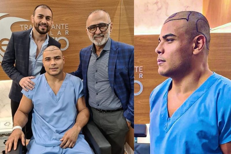 Paulo Costa Trapianto capelli